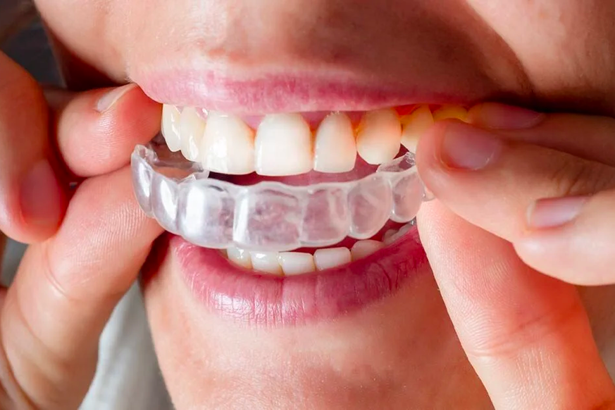 How Can Invisalign Transform Your Smile?